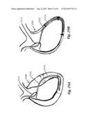 DEVICES AND METHODS FOR ASSISTING CARDIAC FUNCTION diagram and image