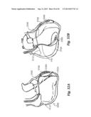 DEVICES AND METHODS FOR ASSISTING CARDIAC FUNCTION diagram and image