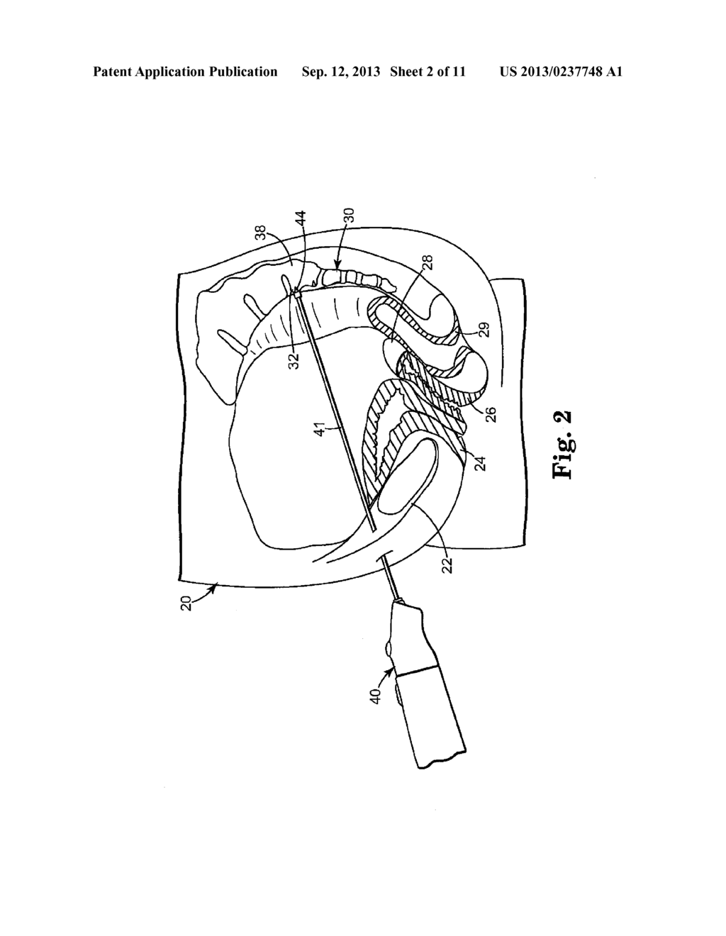 IMPLANTABLE ARTICLE AND METHOD - diagram, schematic, and image 03