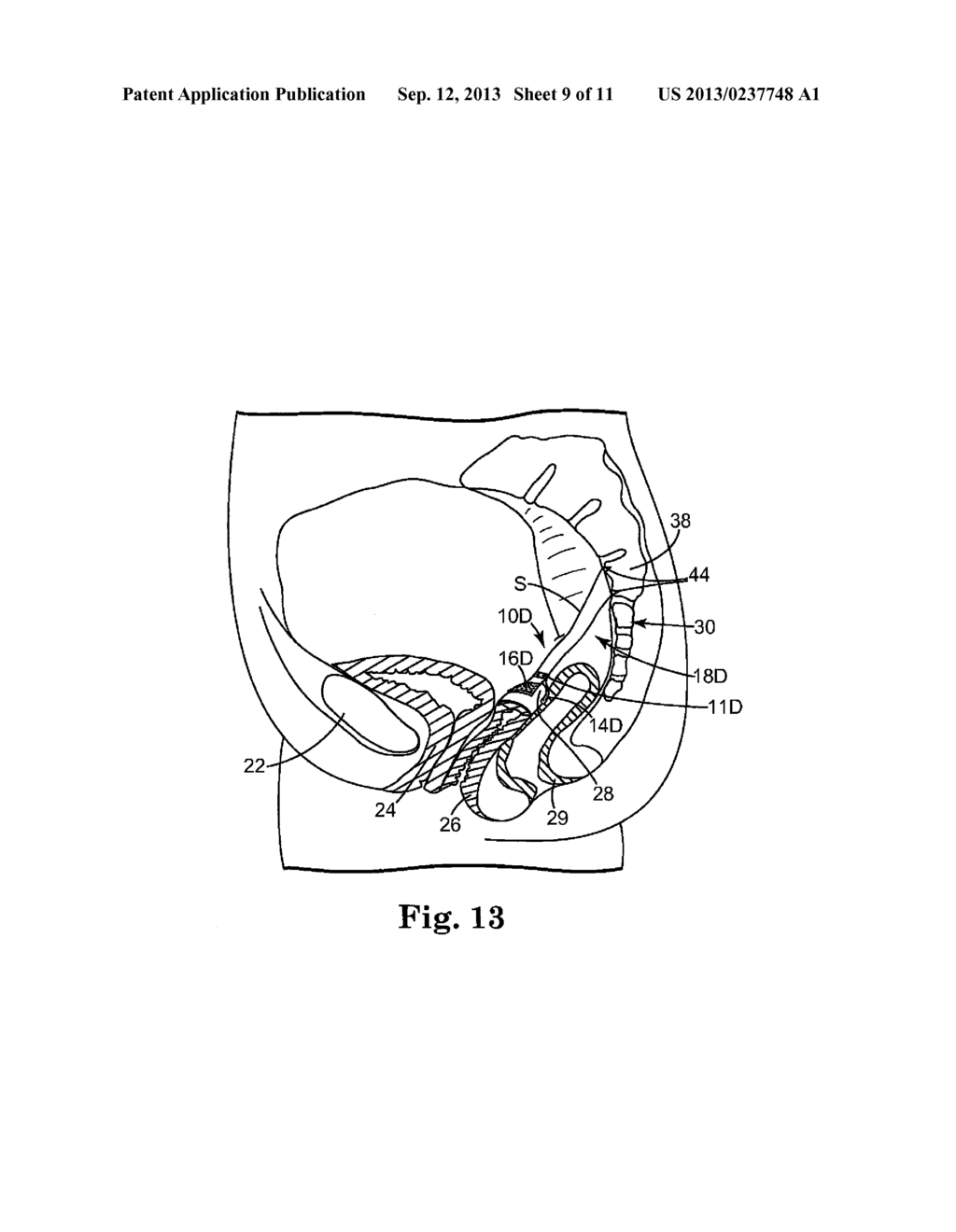 IMPLANTABLE ARTICLE AND METHOD - diagram, schematic, and image 10