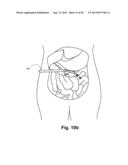 INTERNAL RETRACTOR diagram and image