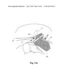 INTERNAL RETRACTOR diagram and image