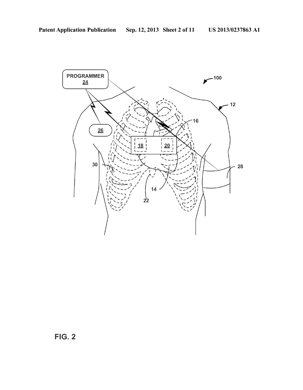 HEART SOUND MONITORING OF PULMONARY HYPERTENSION - diagram, schematic, and image 03