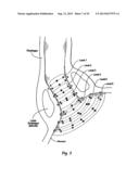 SYSTEMS AND METHODS FOR TREATING TISSUE WITH RADIOFREQUENCY ENERGY diagram and image