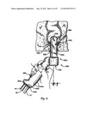 SYSTEMS AND METHODS FOR TREATING TISSUE WITH RADIOFREQUENCY ENERGY diagram and image