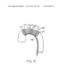 EMBOLIC PROTECTION DEVICE diagram and image