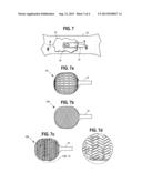 NON-INVASIVE SUTURE ANCHOR AND METHOD diagram and image