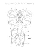 IMPLANTABLE VERTEBRAL FRAME SYSTEMS AND RELATED METHODS FOR SPINAL REPAIR diagram and image