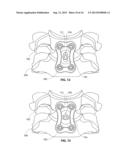 IMPLANTABLE VERTEBRAL FRAME SYSTEMS AND RELATED METHODS FOR SPINAL REPAIR diagram and image