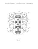 IMPLANTABLE VERTEBRAL FRAME SYSTEMS AND RELATED METHODS FOR SPINAL REPAIR diagram and image