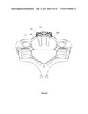 IMPLANTABLE VERTEBRAL FRAME SYSTEMS AND RELATED METHODS FOR SPINAL REPAIR diagram and image