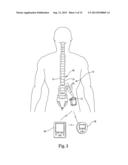 LOW INSERTION FORCE ELECTRICAL CONNECTOR FOR IMPLANTABLE MEDICAL DEVICES diagram and image