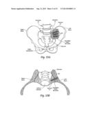 INTEGRATED IMPLANT diagram and image