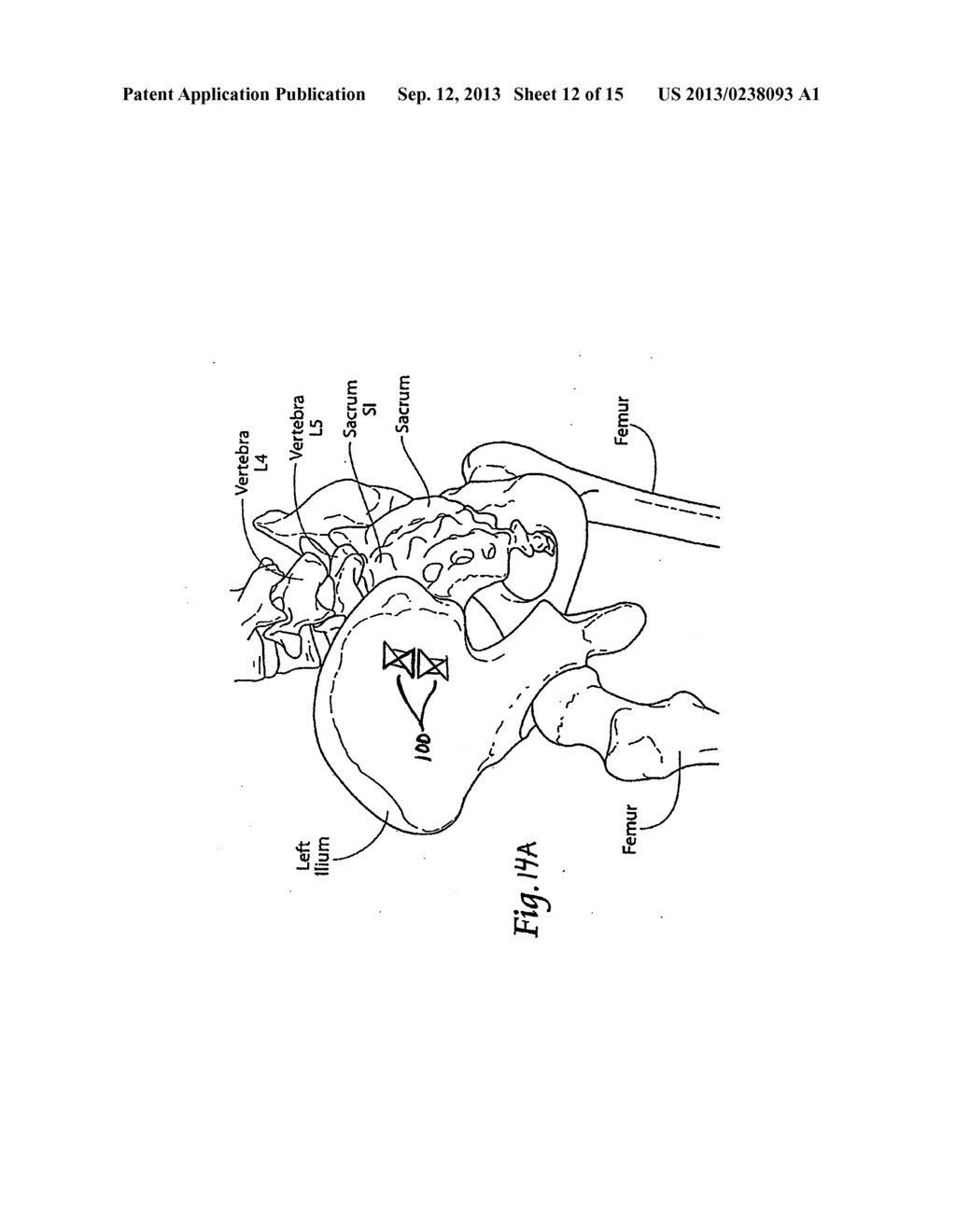 INTEGRATED IMPLANT - diagram, schematic, and image 13