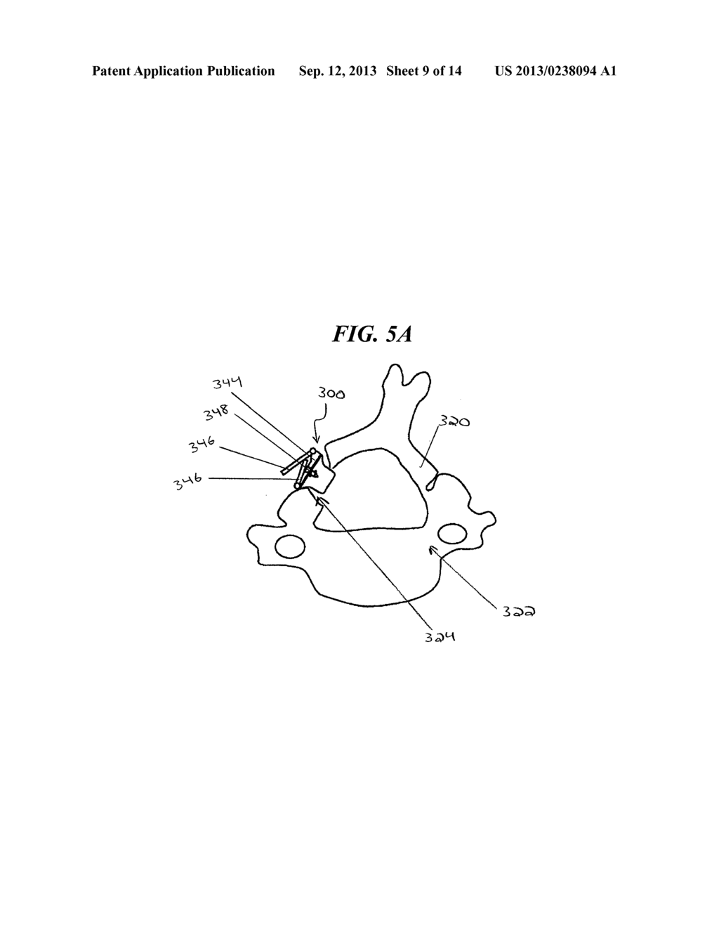 METHODS AND DEVICES FOR EXPANDING A SPINAL CANAL - diagram, schematic, and image 10