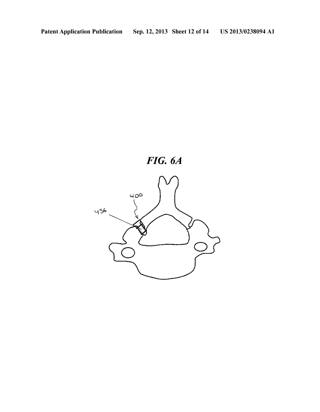 METHODS AND DEVICES FOR EXPANDING A SPINAL CANAL - diagram, schematic, and image 13