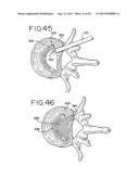 DEVICES FOR TREATING THE SPINE diagram and image