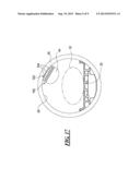 Inflation Support System for MR Guided HIFU diagram and image