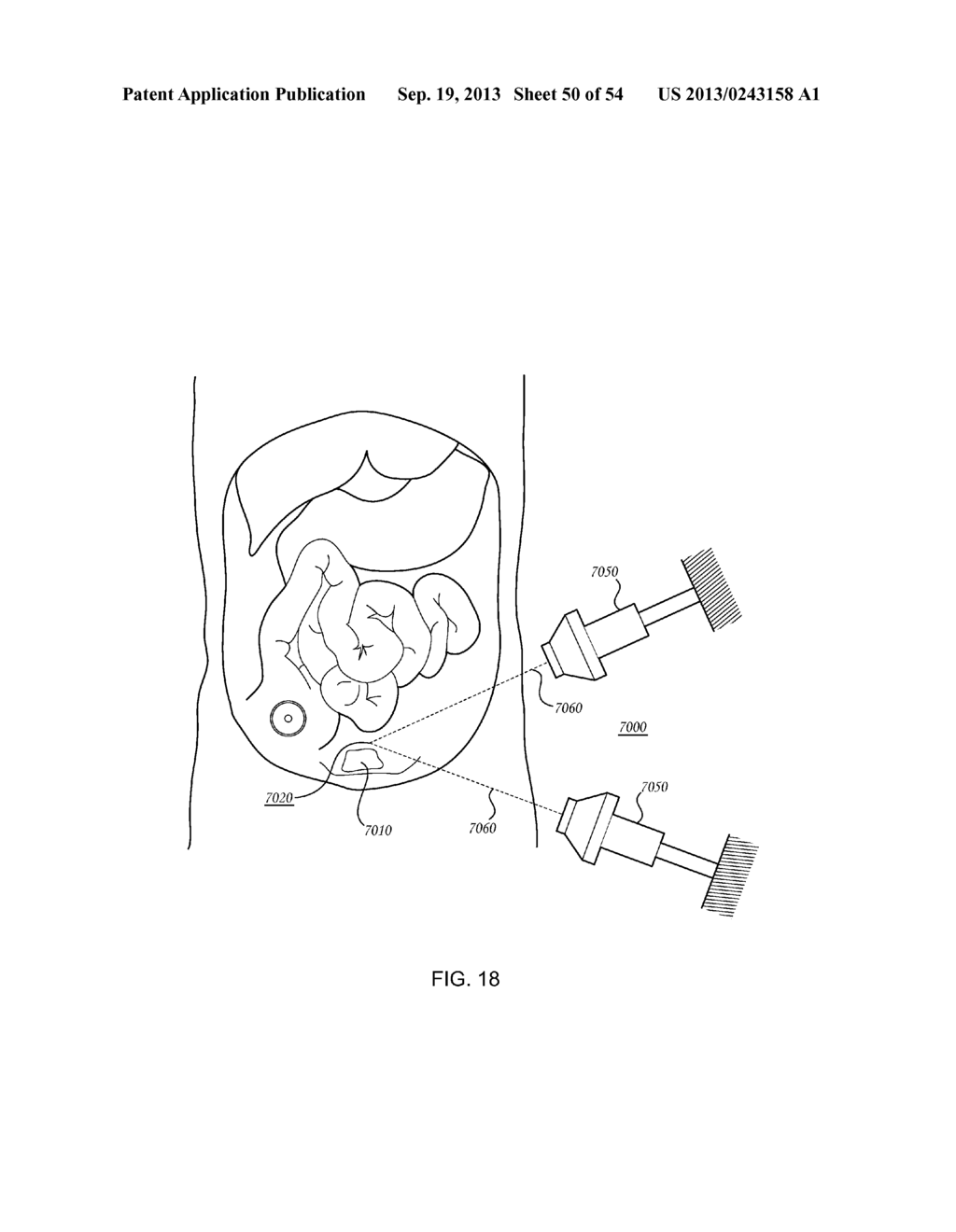 ORTHOVOLTAGE RADIOSURGERY - diagram, schematic, and image 51