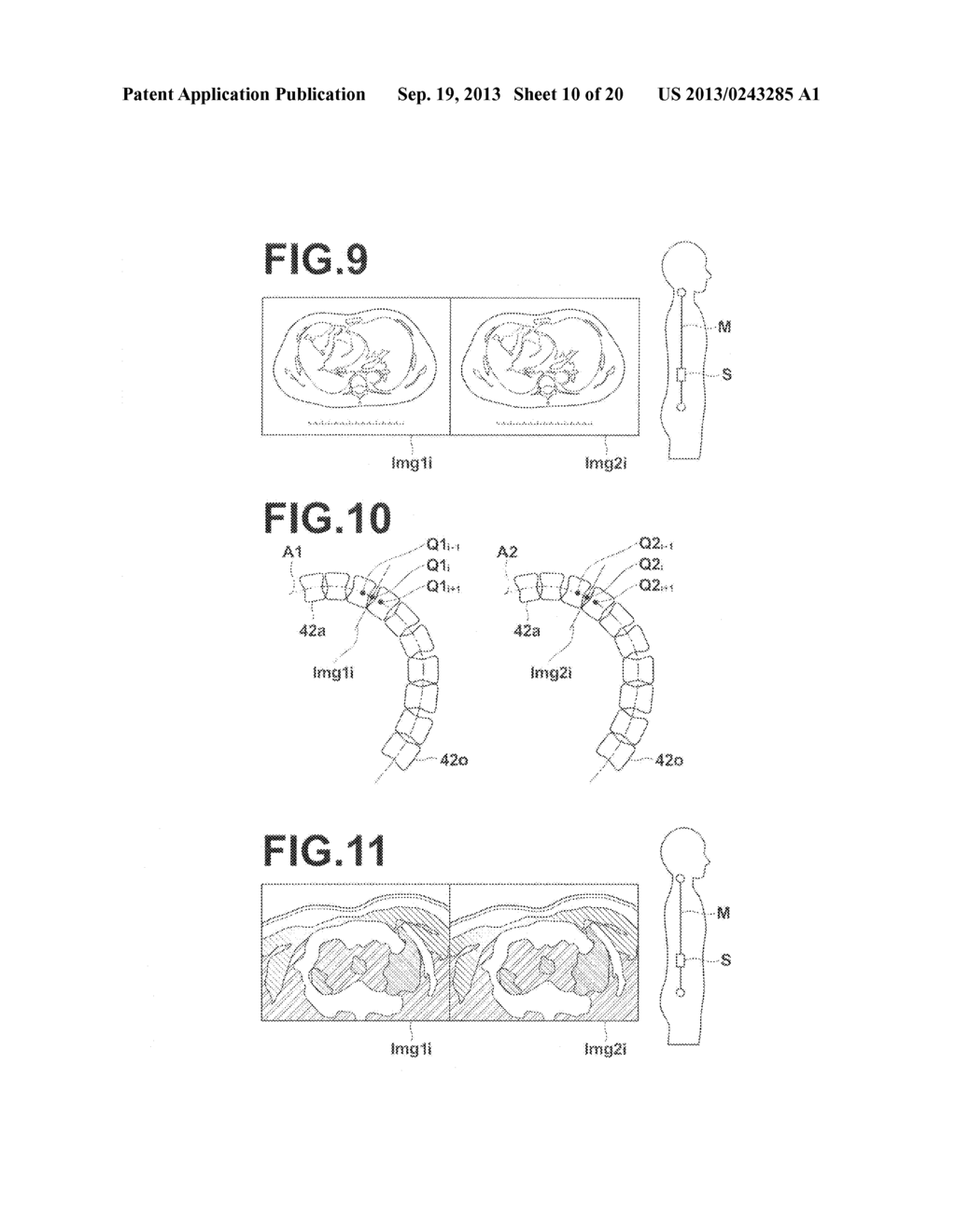 MEDICAL IMAGE ALIGNMENT APPARATUS, METHOD, AND PROGRAM - diagram, schematic, and image 11