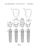 PATIENT-SPECIFIC SYSTEM FOR RESTORING MISSING DENTITION diagram and image