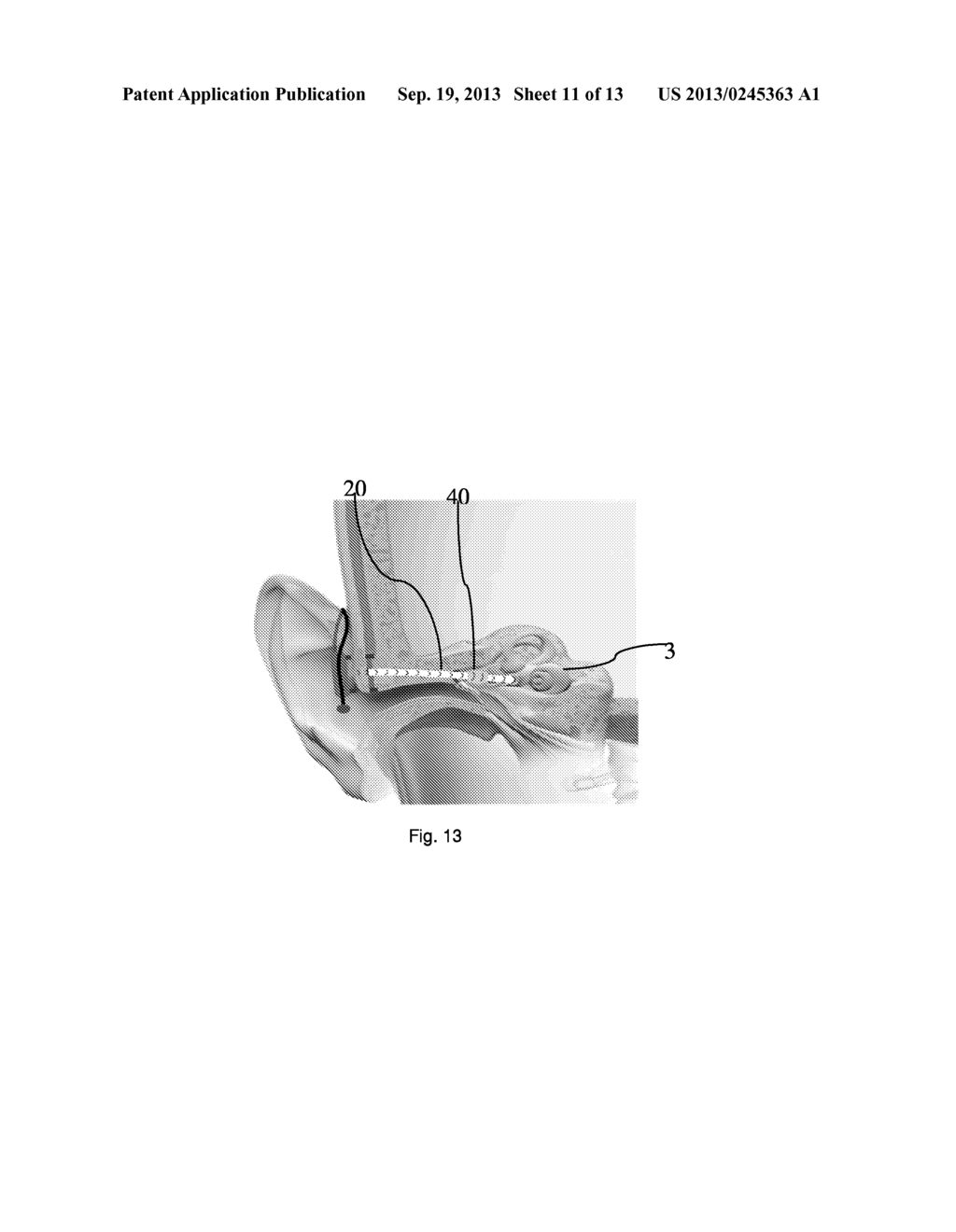 ACOUSTICAL TRANSMISSION MEANS AND METHOD FOR TRANSMITTING SOUND - diagram, schematic, and image 12