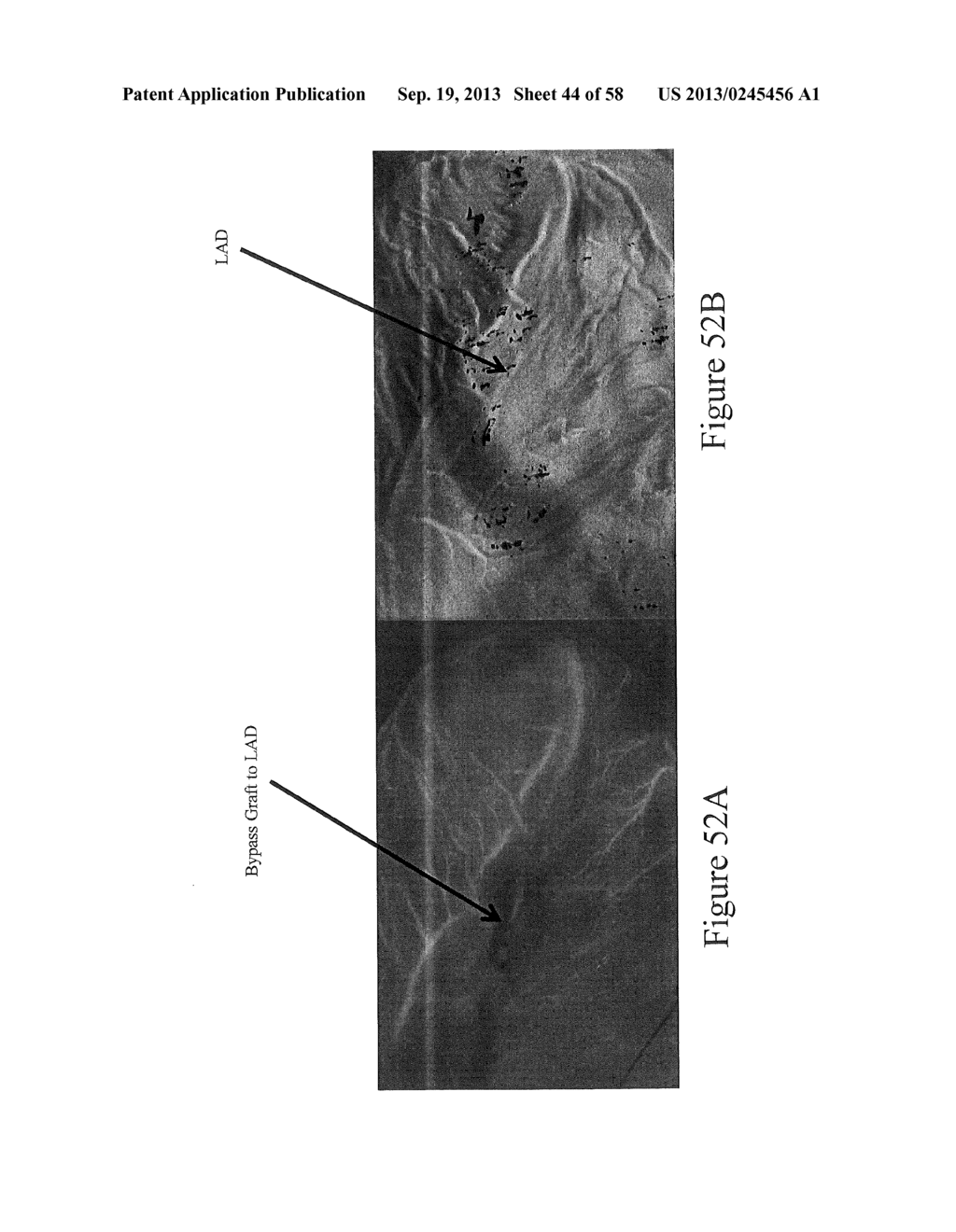 Methods, Systems and Computer Program Products for Non-Invasive     Determination of Blood Flow Distribution Using Speckle Imaging Techniques     and Hemodynamic Modeling - diagram, schematic, and image 45