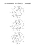MINIMALLY INVASIVE DETERMINATION OF COLLATERAL VENTILATION IN LUNGS diagram and image