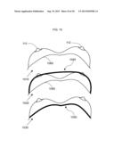 METHOD FOR FACILITATING BREAST IMPLANT PROCEDURE DECISIONS diagram and image