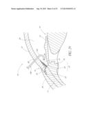 OCULAR IMPLANT SYSTEM diagram and image