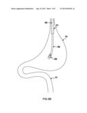 APPARATUS AND METHOD USED WITH GUIDANCE SYSTEM FOR FEEDING AND SUCTIONING diagram and image