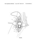 SUBCUTANEOUS VASCULAR ACCESS PORTS HAVING ATTACHMENT FEATURES diagram and image