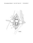 SUBCUTANEOUS VASCULAR ACCESS PORTS HAVING ATTACHMENT FEATURES diagram and image