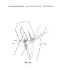 SUBCUTANEOUS VASCULAR ACCESS PORTS HAVING ATTACHMENT FEATURES diagram and image