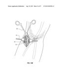 SUBCUTANEOUS VASCULAR ACCESS PORTS HAVING ATTACHMENT FEATURES diagram and image