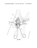 SUBCUTANEOUS VASCULAR ACCESS PORTS HAVING ATTACHMENT FEATURES diagram and image