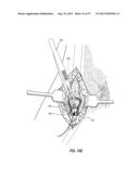 SUBCUTANEOUS VASCULAR ACCESS PORTS HAVING ATTACHMENT FEATURES diagram and image