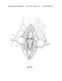 SUBCUTANEOUS VASCULAR ACCESS PORTS HAVING ATTACHMENT FEATURES diagram and image