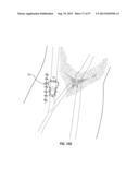 SUBCUTANEOUS VASCULAR ACCESS PORTS HAVING ATTACHMENT FEATURES diagram and image