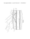 SUBCUTANEOUS VASCULAR ACCESS PORTS HAVING ATTACHMENT FEATURES diagram and image