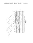 SUBCUTANEOUS VASCULAR ACCESS PORTS HAVING ATTACHMENT FEATURES diagram and image