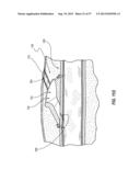 SUBCUTANEOUS VASCULAR ACCESS PORTS HAVING ATTACHMENT FEATURES diagram and image