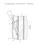 SUBCUTANEOUS VASCULAR ACCESS PORTS HAVING ATTACHMENT FEATURES diagram and image