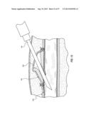 SUBCUTANEOUS VASCULAR ACCESS PORTS HAVING ATTACHMENT FEATURES diagram and image