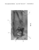 SUBCUTANEOUS VASCULAR ACCESS PORTS HAVING ATTACHMENT FEATURES diagram and image