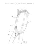 SUBCUTANEOUS VASCULAR ACCESS PORTS HAVING ATTACHMENT FEATURES diagram and image