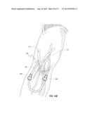 SUBCUTANEOUS VASCULAR ACCESS PORTS HAVING ATTACHMENT FEATURES diagram and image