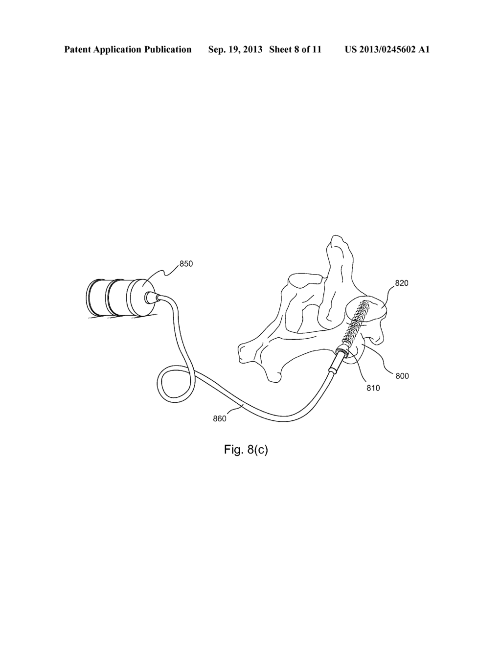 METHOD AND DEVICE FOR DELIVERING MEDICINE TO BONE - diagram, schematic, and image 09