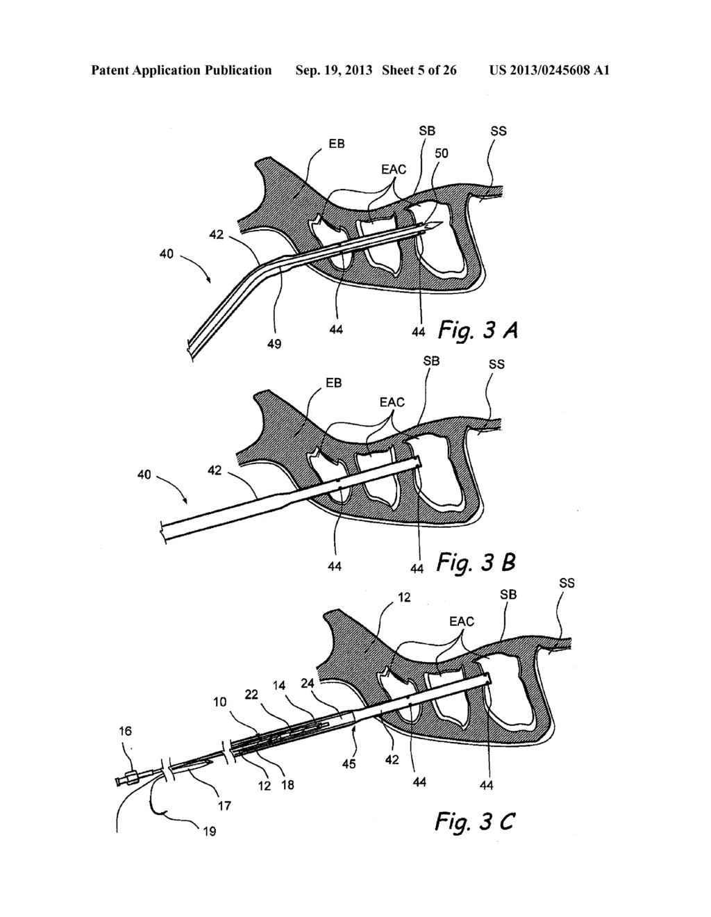 IMPLANTABLE DEVICES AND METHODS FOR TREATING SINUSITIS AND OTHER DISORDERS - diagram, schematic, and image 06