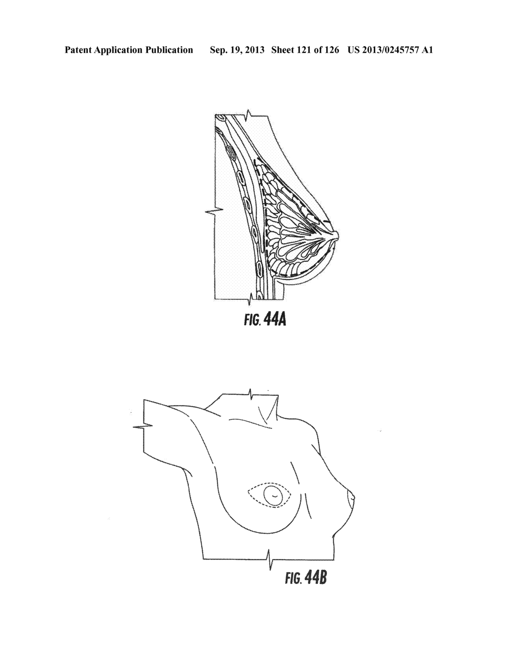 METHOD AND DEVICE FOR IMPROVED SOFT TISSUE SURGERY - diagram, schematic, and image 122